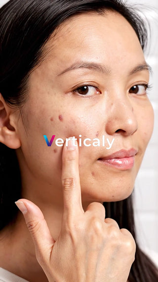 ニキビを気にする女性