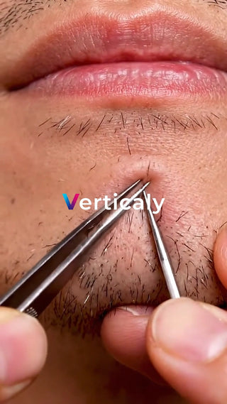 ニキビを処理する男性