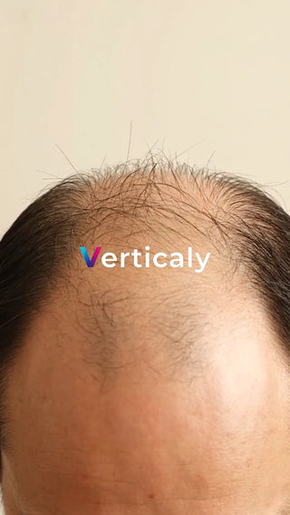 薄毛を気にする男性