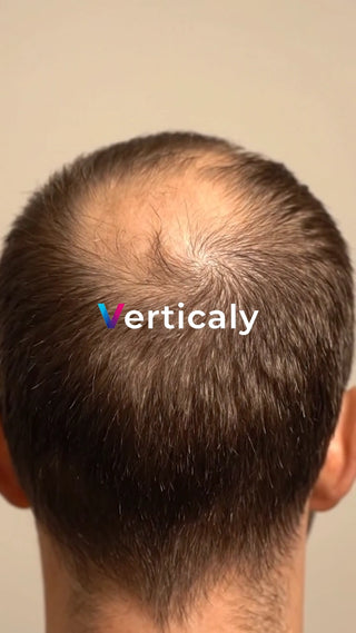 薄毛の頭頂部を真上から