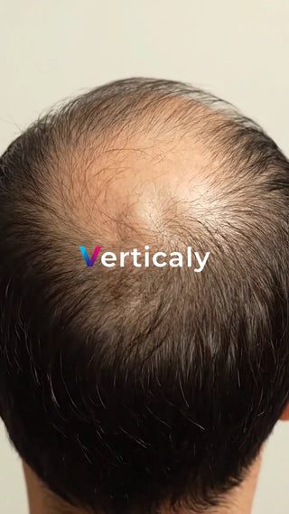 薄毛の頭皮、頭頂部アップ