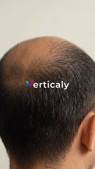 薄毛の頭頂部を真上から