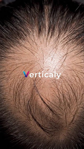 薄毛の頭皮を真上から