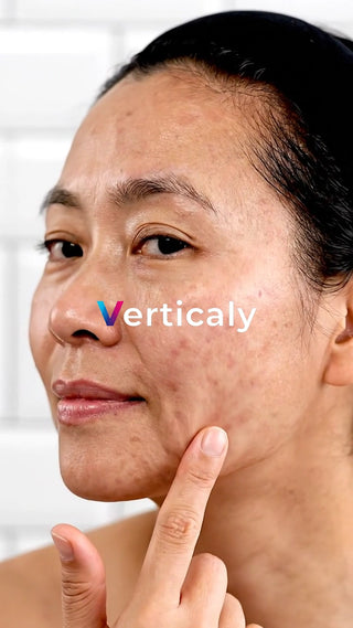 ニキビ跡を気にする女性