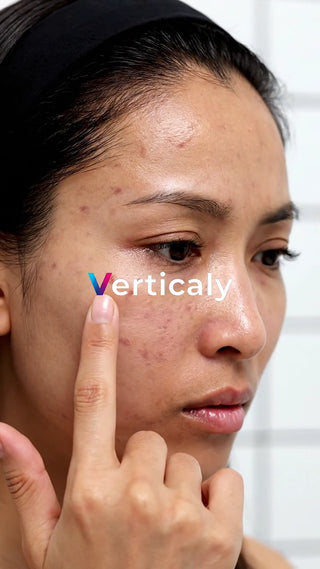 ニキビ跡を気にする女性